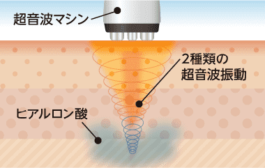 美容液導入 イメージ